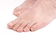 Foot Neuropathy, Fatty Liver & Iron Overload