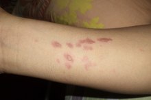 Side Effects of Burning Skin