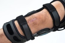 Complications After Partial Knee Replacement