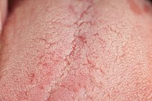Multiple Sclerosis Symptoms Involving the Tongue
