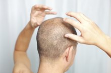 Widow's Peak and Hair Loss