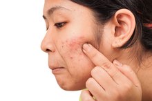 Acne & Warts