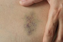 How to Care for a Black & Blue Injury