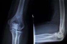 Torn Tendons & Ligaments From Hyperextension