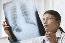 Lung Cancer & Low Potassium