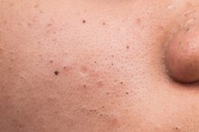 What Is the Difference Between Clogged Pores & Acne?