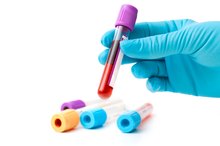 What Are the Dangers of Low Ferritin?