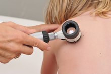 Skin Moles in Children