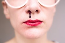 Oxygen & Severe Nosebleeds