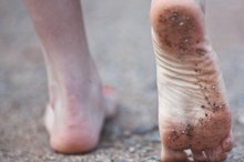 Fissures & Athlete's Feet Treatment