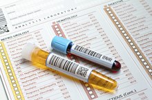 Causes of White Blood Cells in Urine