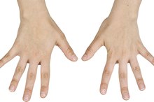 How to Get Rid of a Bone Spur on a Finger