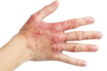 Crisco for Eczema