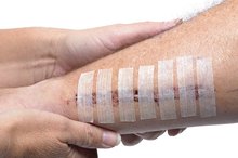 A Healing Scar Turned Blue
