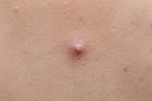Embedded Blackheads & Pits