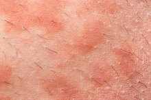 Follicular Eczema