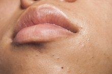 Oil Bumps on the Face