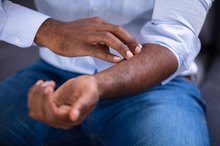 How to Get Rid of an Allergic Reaction Rash