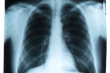 Breathing Exercises for Fluid in Lungs