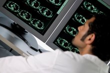 Exercises for Mouth Droop After a Stroke