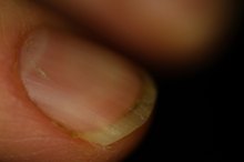 Can Vitamin C Cure Nail Fungus?