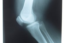 How to Pop an Elbow Joint