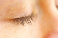 Flaky, Crusty Peeling Skin on Eyelids