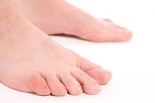 Ingrown Toenail on the Pinky