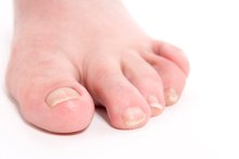 What Do Ridges in Toenails Mean?