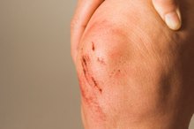 Rehabilitation for a Broken Kneecap
