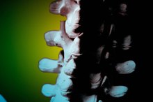 Can the L4 Nerve Cause Groin Pain and Limping When Walking?