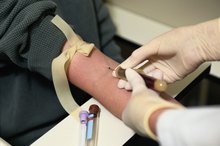 How to Treat Elevated Liver Enzymes ALT & AST