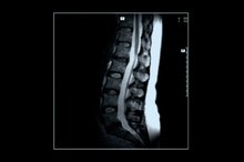 Complications of Lumbar Fusion Surgery