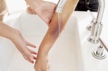 Iron Dosages for Anemia With Bruising