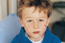 A Pimple-Like Rash All Over the Body