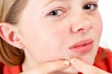 Home Remedy for an Infected Pimple