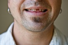 How to Cover Missing Teeth in Your Mouth