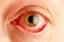 Causes of Eye Discoloring