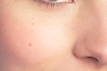 How to Lance a Sty Inside the Eye