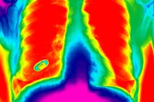 Symptoms of Food in the Lungs