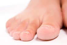 How to Flatten a Curved Toenail