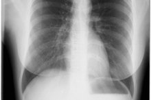 Symptoms of Thoracic Spine Problems