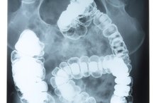 How Does Caffeine Affect the Bowels of a Person Who Has Acute Chronic Gastritis & Diverticulitis?