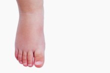 Exercises for Leg Edema