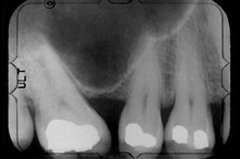 How to Hide Tooth Decay