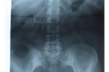 Can You Do Situps After Hip Replacements?