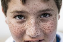 Brown Spots on the Eye
