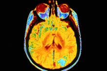 What Is Stage 4 Brain Cancer?