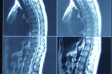 Can an Inversion Table Help With Bulging Disks?