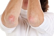 Menopause & Eczema
